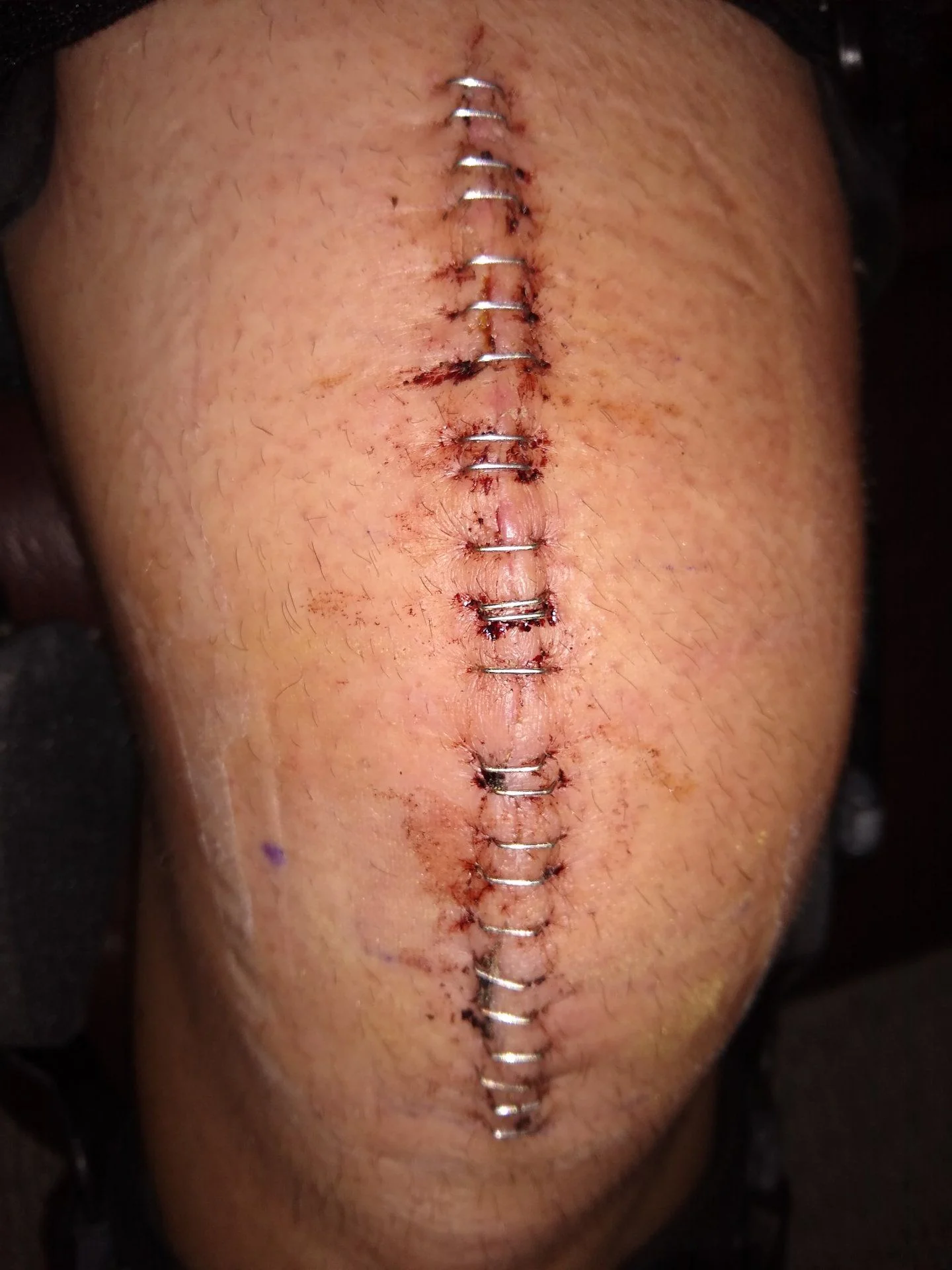 Knee Staples.webp