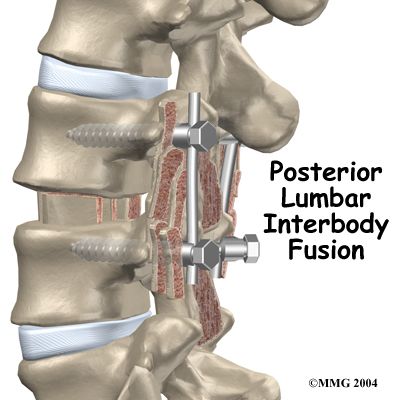lumbar_PLIF_intro01.jpg